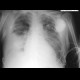 Lobar pneumonia: X-ray - Plain radiograph